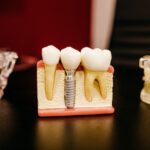 implanty zębów w Szczecinie